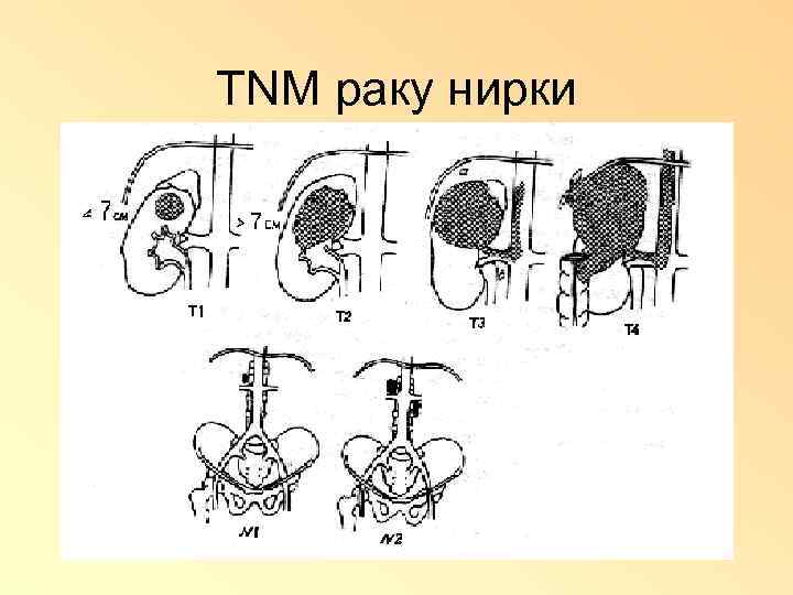 ТNМ раку нирки 