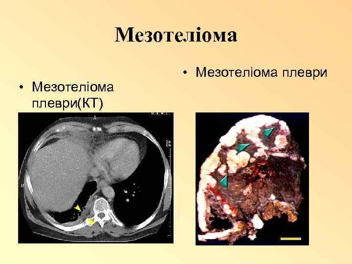 Мезотеліома • Мезотеліома плеври(КТ) • Мезотеліома плеври 