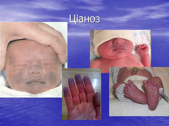 Ціаноз 
