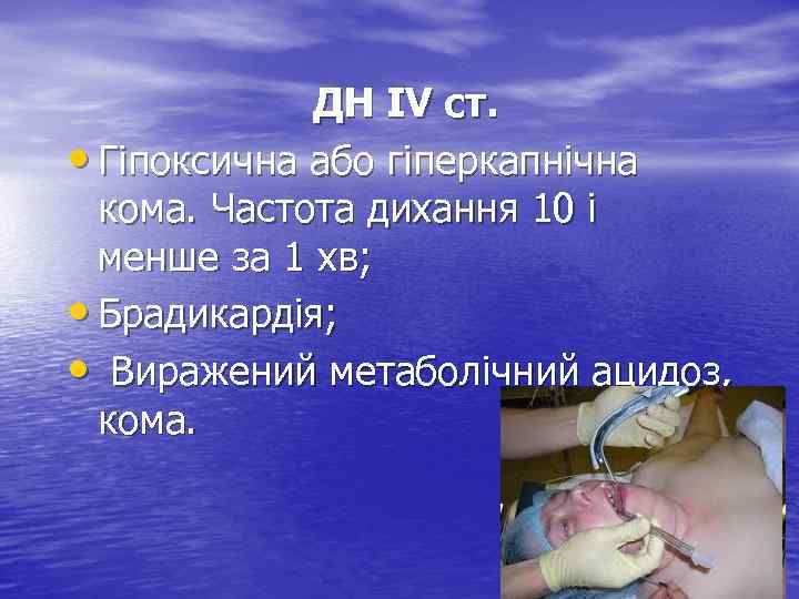 ДН IV ст. • Гіпоксична або гіперкапнічна кома. Частота дихання 10 і менше за