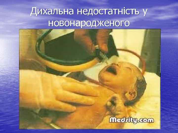 Дихальна недостатність у новонародженого 