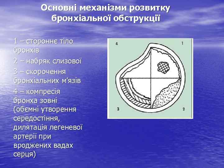Основні механізми розвитку бронхіальної обструкції 1 – стороннє тіло бронхів 2 – набряк слизової