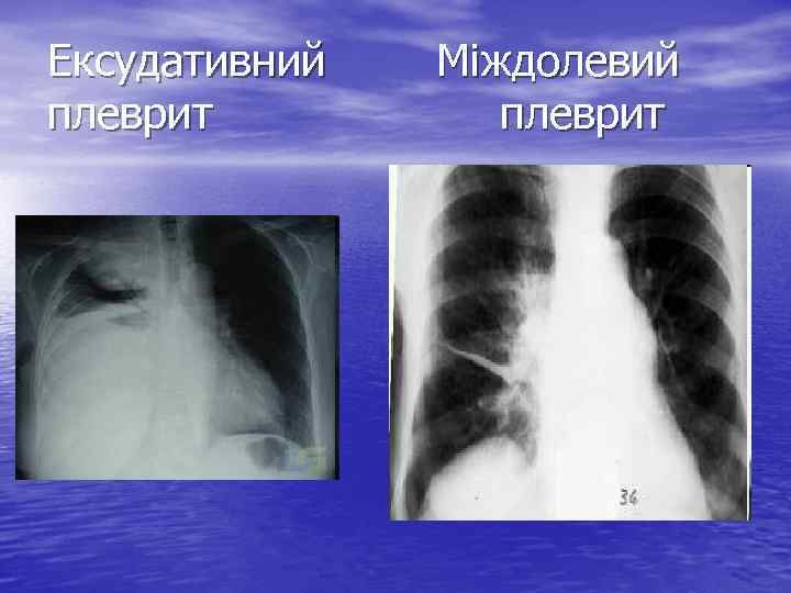 Ексудативний плеврит Міждолевий плеврит 