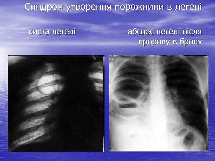 Синдром утворення порожнини в легені киста легені абсцес легені після прориву в бронх 