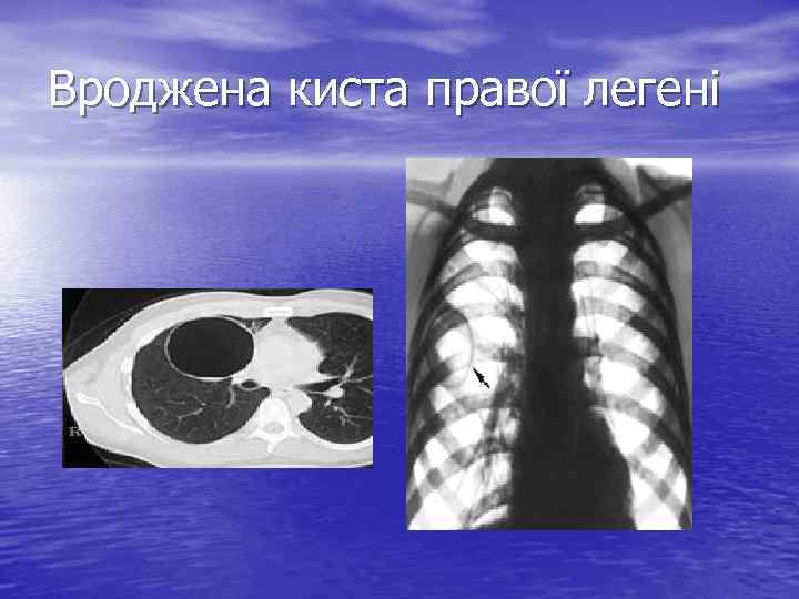 Вроджена киста правої легені 