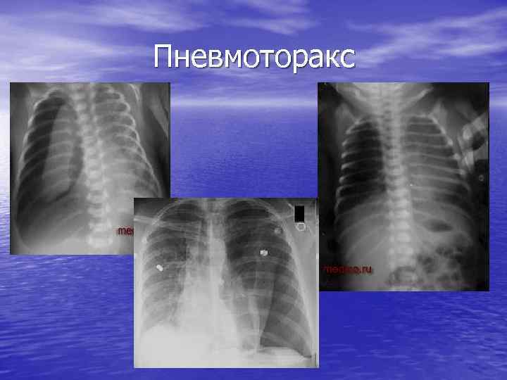 Пневмоторакс 