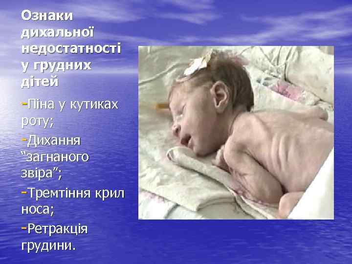 Ознаки дихальної недостатності у грудних дітей -Піна у кутиках роту; -Дихання “загнаного звіра”; -Тремтіння