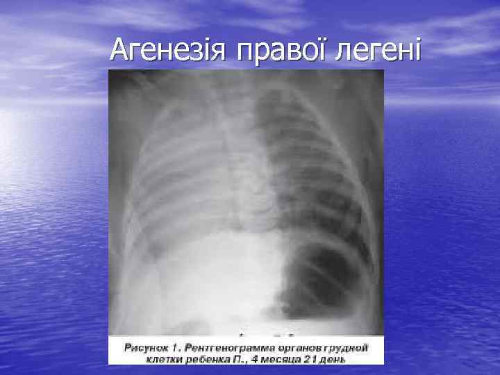 Агенезія правої легені 