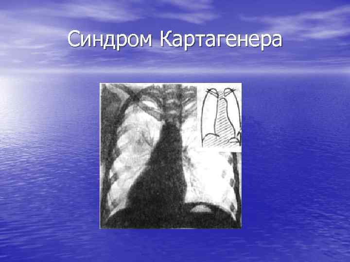 Синдром Картагенера 