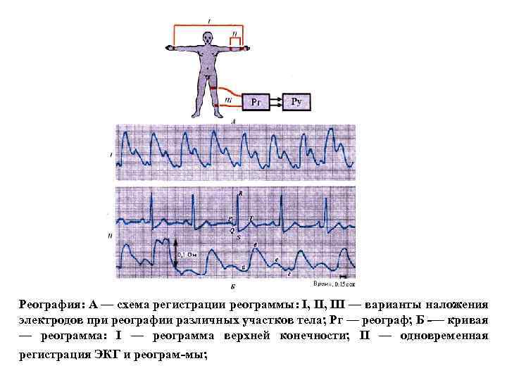 Реография: А — схема регистрации реограммы: I, III — варианты наложения электродов при реографии