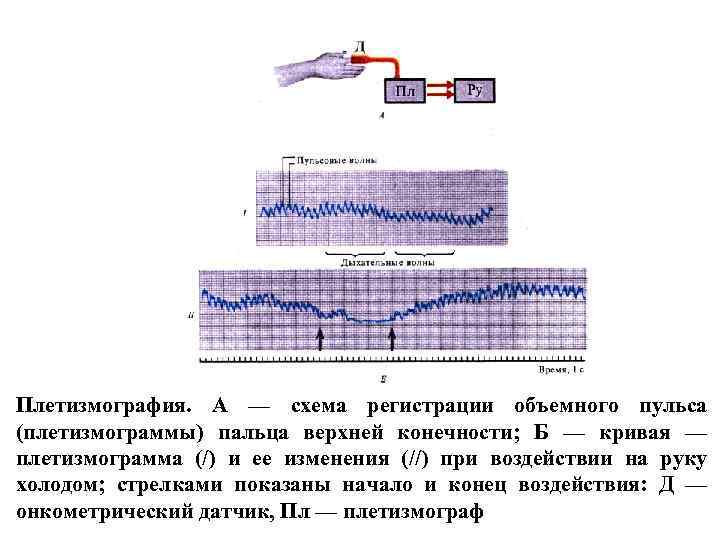 Плетизмография. А — схема регистрации объемного пульса (плетизмограммы) пальца верхней конечности; Б — кривая