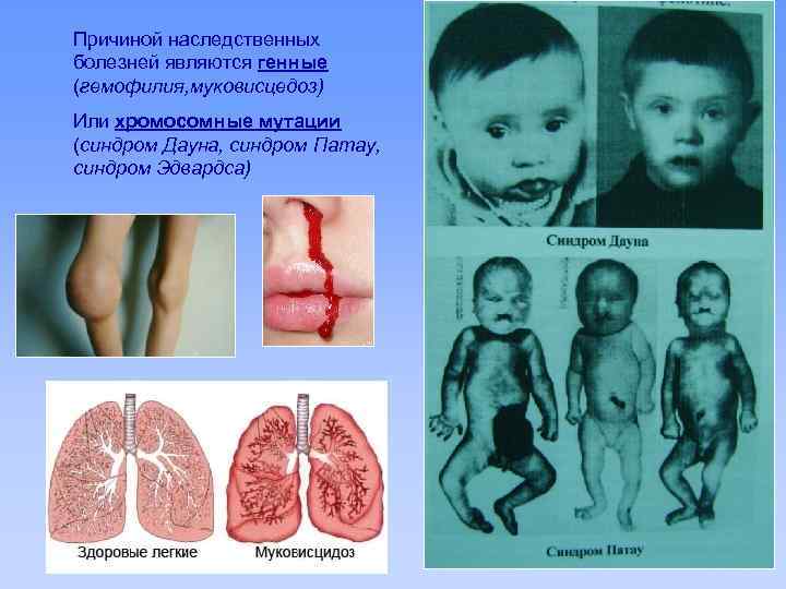 Причиной наследственных болезней являются генные (гемофилия, муковисцедоз) Или хромосомные мутации (синдром Дауна, синдром Патау,