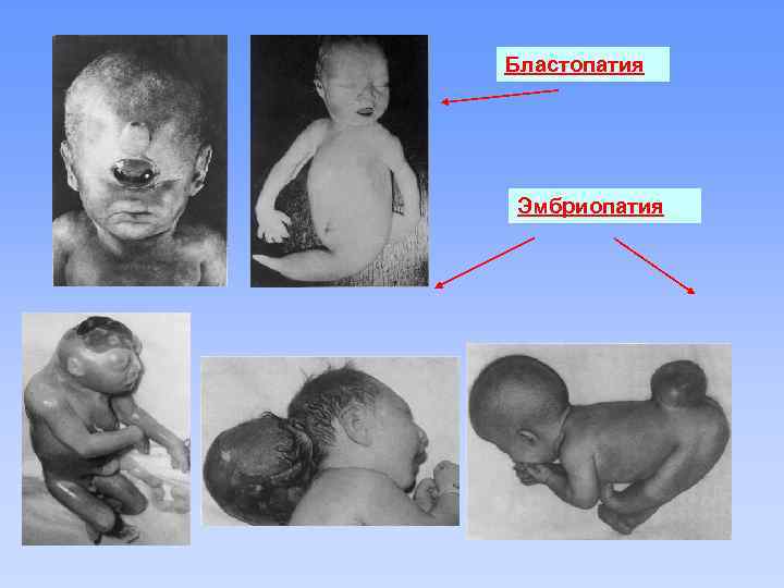 Бластопатия Эмбриопатия 