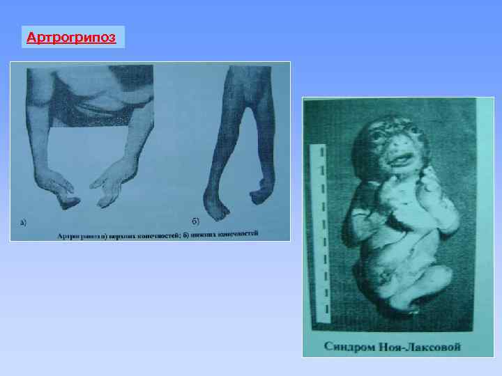 Артрогрипоз 