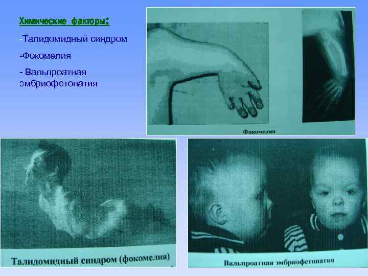 Химические факторы: -Талидомидный синдром -Фокомелия - Вальпроатная эмбриофетопатия 