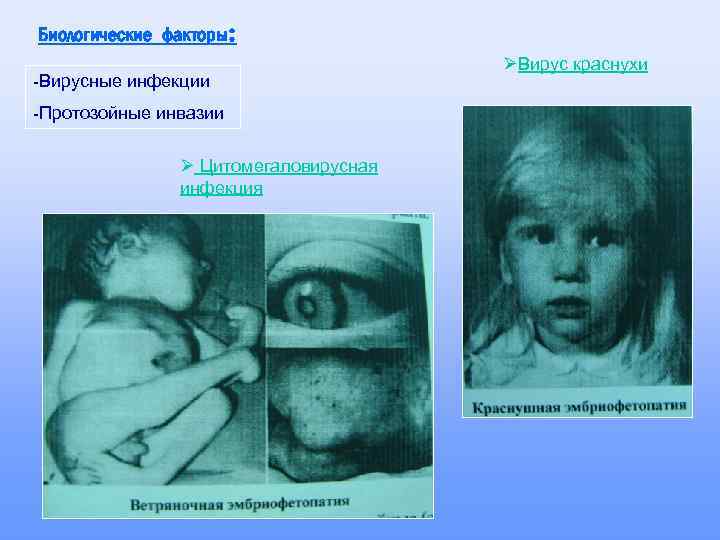 Биологические факторы: -Вирусные инфекции -Протозойные инвазии Ø Цитомегаловирусная инфекция ØВирус краснухи 