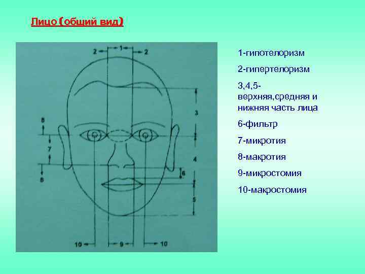 Лицо (общий вид) 1 -гипотелоризм 2 -гипертелоризм 3, 4, 5 верхняя, средняя и нижняя