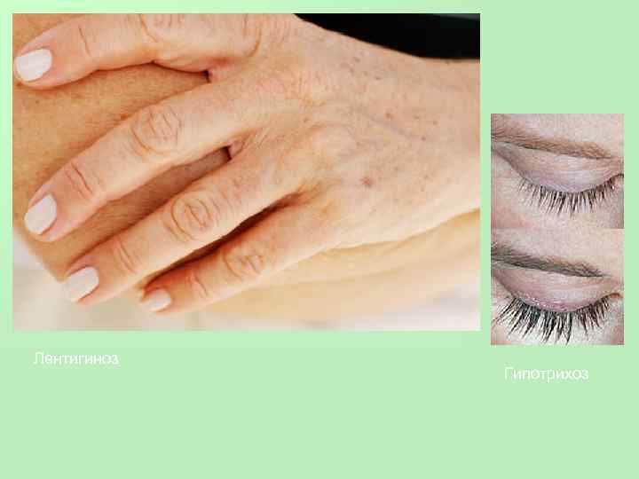 Лентигиноз Гипотрихоз 
