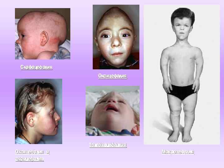 Скафоцефалия Оксицефалия Тригоноцефаллия Оксицефалия и акроцефалия Макроцефалия 