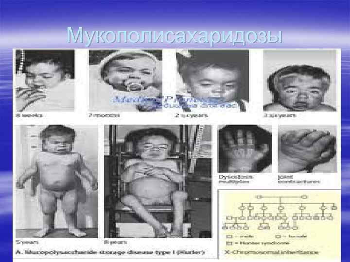 Мукополисахаридозы § Мукополисахаридозы 