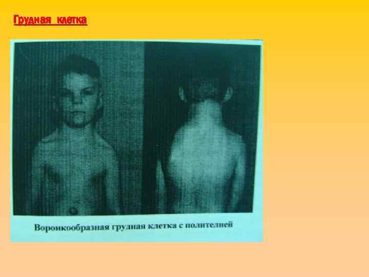 Грудная клетка 