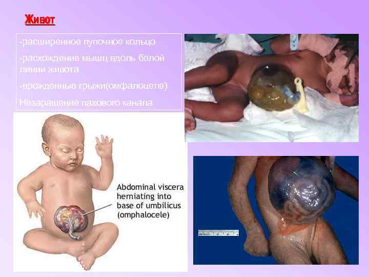 Живот -расширенное пупочное кольцо -расхождение мышц вдоль белой линии живота -врожденные грыжи(омфалоцеле) Незаращение пахового