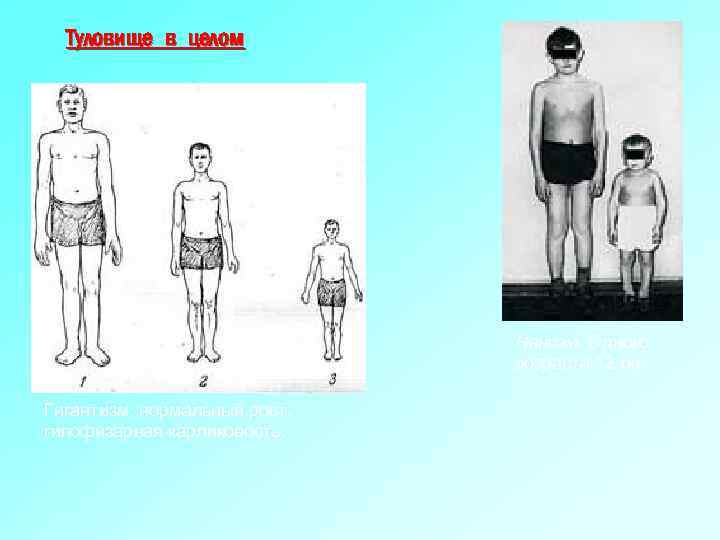Гигантизм тела. Гигантизм отдельных частей тела. Гипофизарная карликовость. Гипофизарный гигантизм.