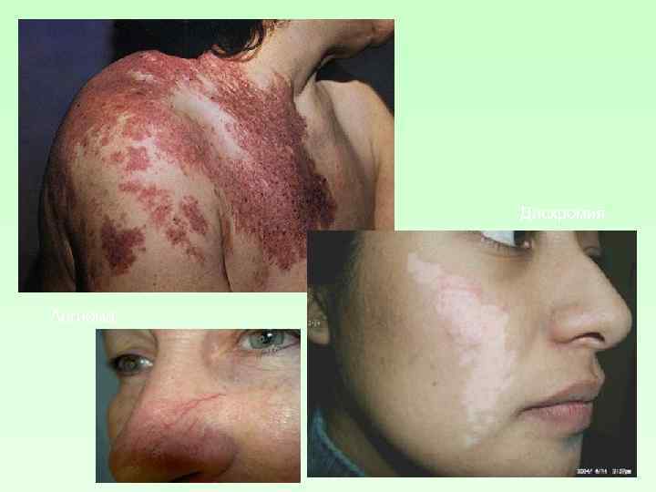 Дисхромия Ангиома 
