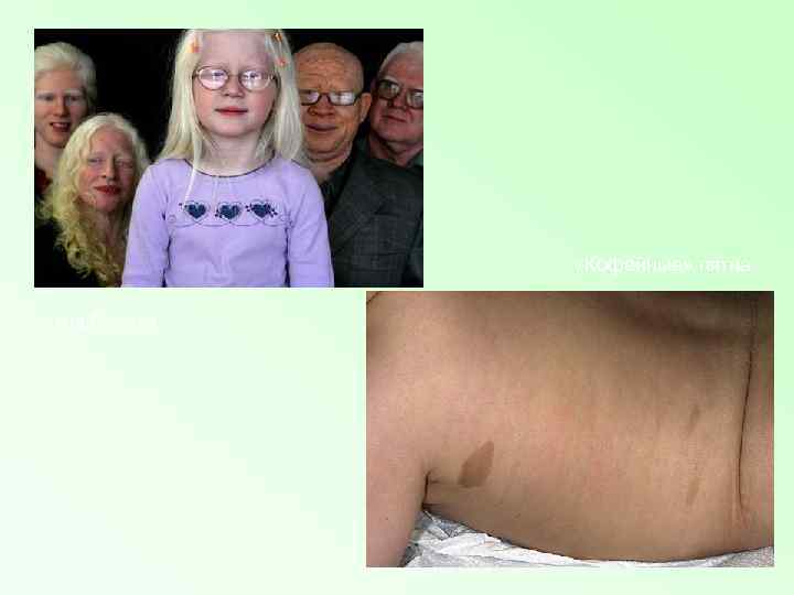  «Кофейные» пятна Альбинизм 