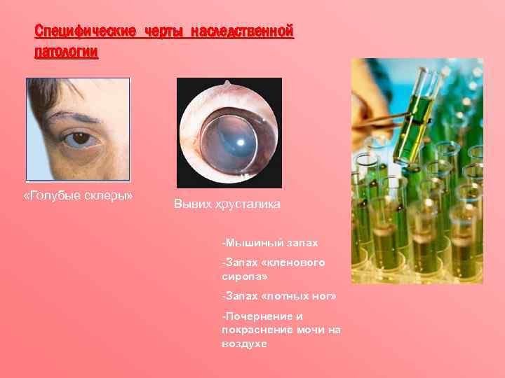 Специфические черты наследственной патологии «Голубые склеры» Вывих хрусталика -Мышиный запах -Запах «кленового сиропа» -Запах