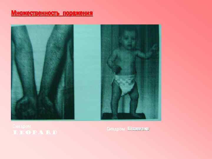 Множественность поражения Синдром LEOPARD Синдром Швахмана 