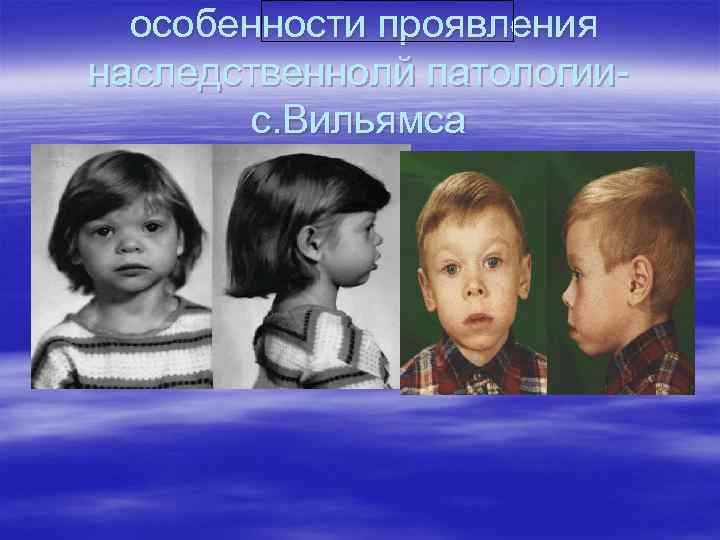 особенности проявления наследственнолй патологиис. Вильямса 