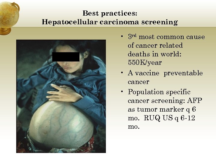 Best practices: Hepatocellular carcinoma screening • 3 rd most common cause of cancer related