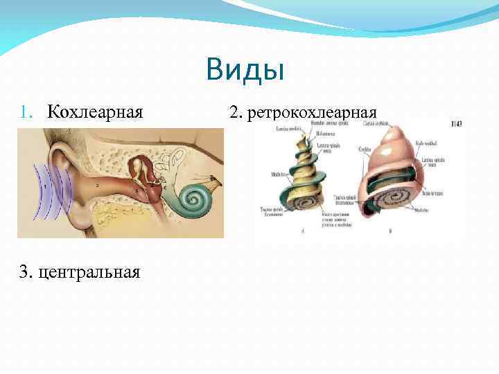 Виды 1. Кохлеарная 3. центральная 2. ретрокохлеарная 