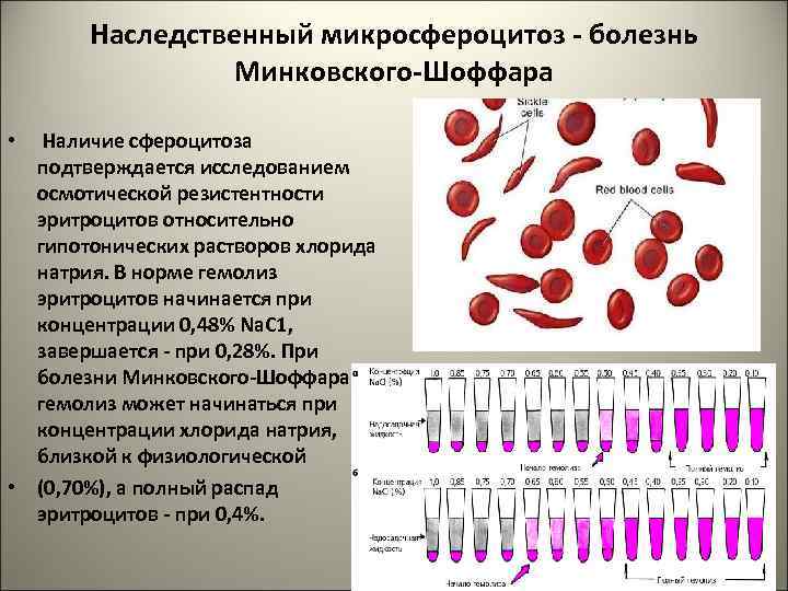 Наследственный микросфероцитоз - болезнь Минковского-Шоффара • Наличие сфероцитоза подтверждается исследованием осмотической резистентности эритроцитов относительно