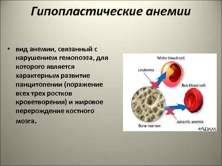 Гипопластические анемии • вид анемии, связанный с нарушением гемопоэза, для которого является характерным развитие