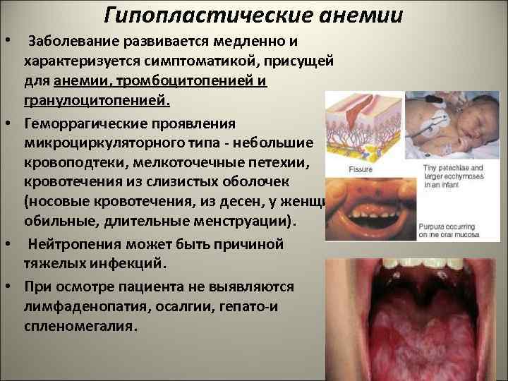 Гипопластические анемии • Заболевание развивается медленно и характеризуется симптоматикой, присущей для анемии, тромбоцитопенией и