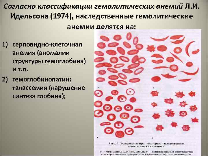 Согласно классификации гемолитических анемий Л. И. Идельсона (1974), наследственные гемолитические анемии делятся на: 1)