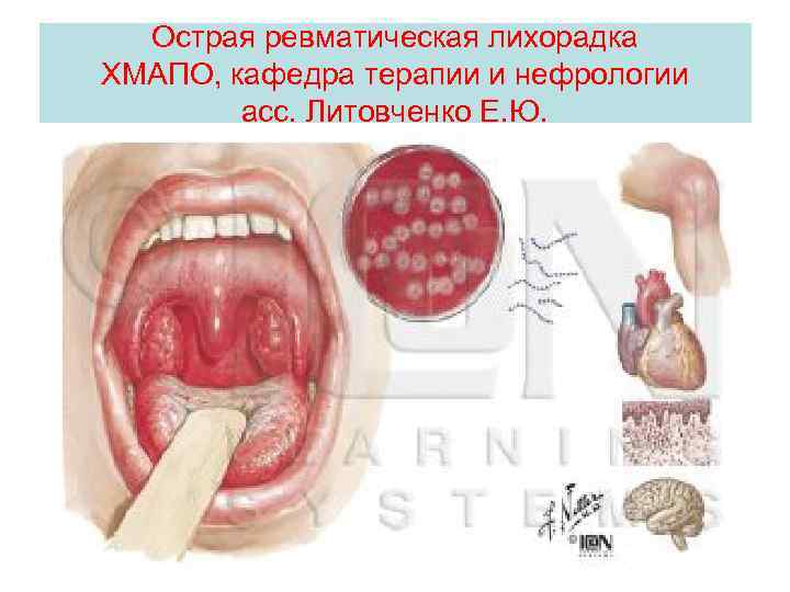 Острая ревматическая лихорадка ХМАПО, кафедра терапии и нефрологии асс. Литовченко Е. Ю. 