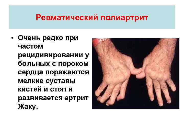 Ревматический полиартрит • Очень редко при частом рецидивировании у больных с пороком сердца поражаются