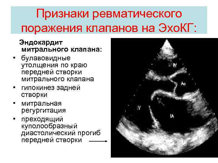 Эндокардит миокардит перикардит презентация