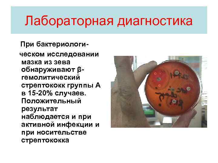 Лабораторная диагностика При бактериологическом исследовании мазка из зева обнаруживают βгемолитический стрептококк группы А в