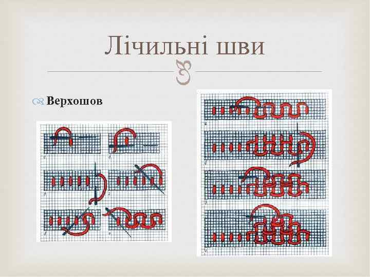  Лічильні шви Верхошов 