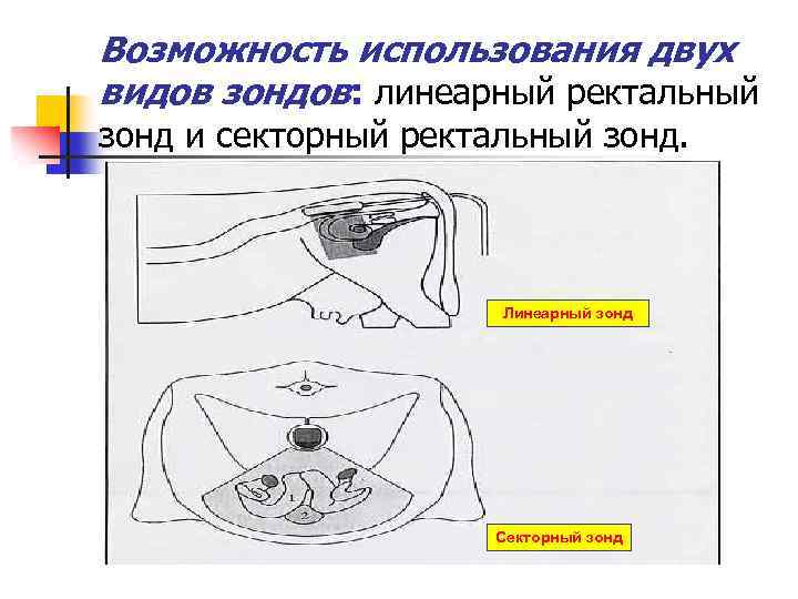 Возможность использования двух видов зондов: линеарный ректальный зонд и секторный ректальный зонд. Линеарный зонд