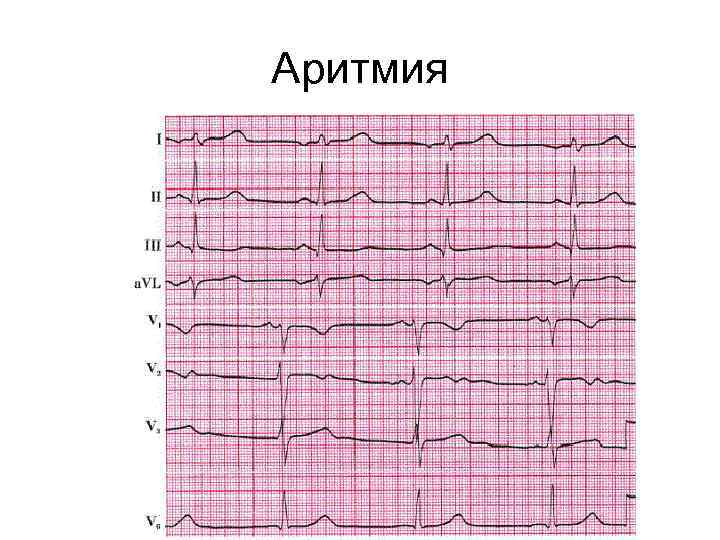 Аритмия 