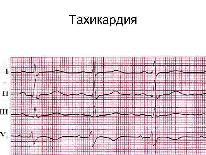 Тахикардия 