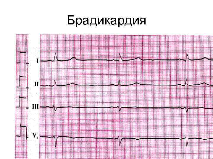 Брадикардия 