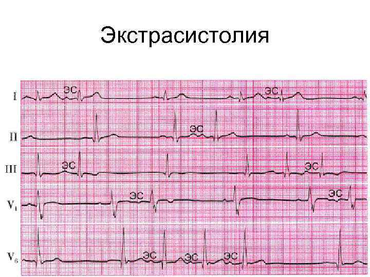 Экстрасистолия 