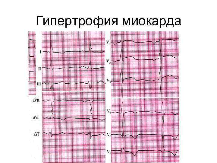 Гипертрофия миокарда 