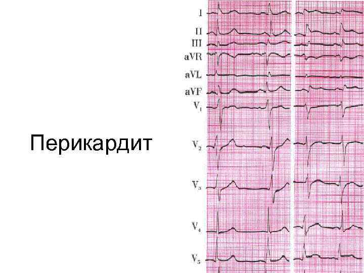 Перикардит 